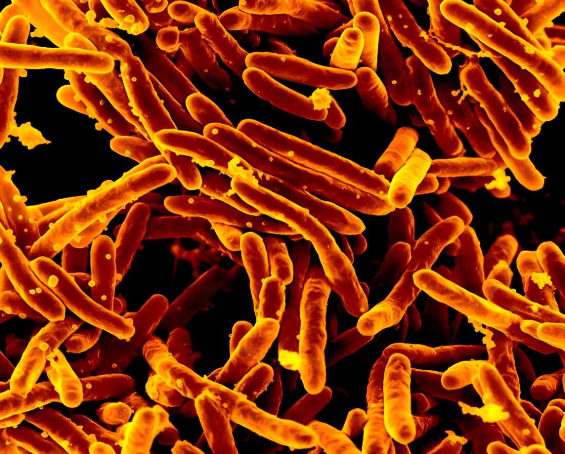 Long a dream, it’s now real: a fast and accurate TB test that doesn’t need phlegm