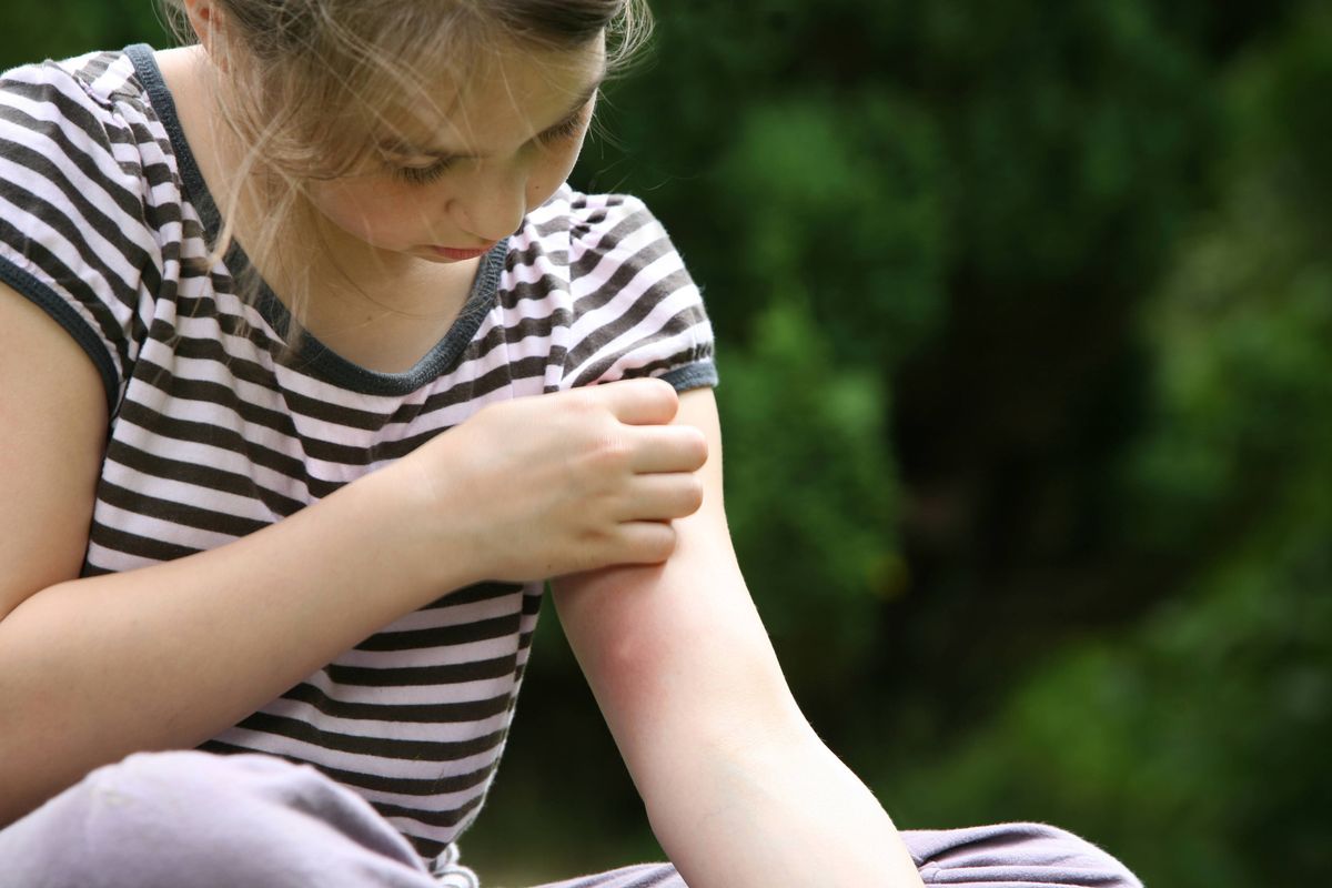 Doctor’s ‘life-changing’ tip may help stop mosquito bites itching in seconds