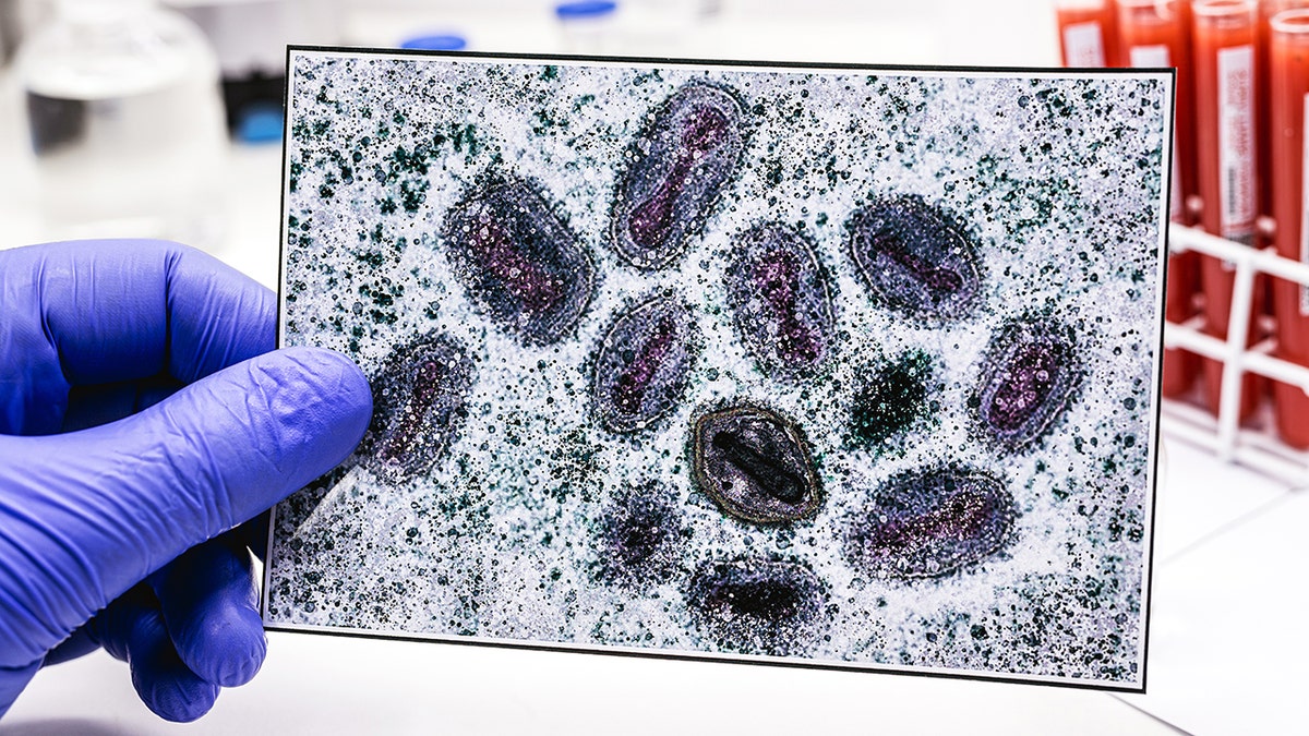 First clade I mpox case confirmed in Connecticut after patient traveled to Western Europe