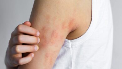 New eczema treatments spark hope, but remain out of reach for many