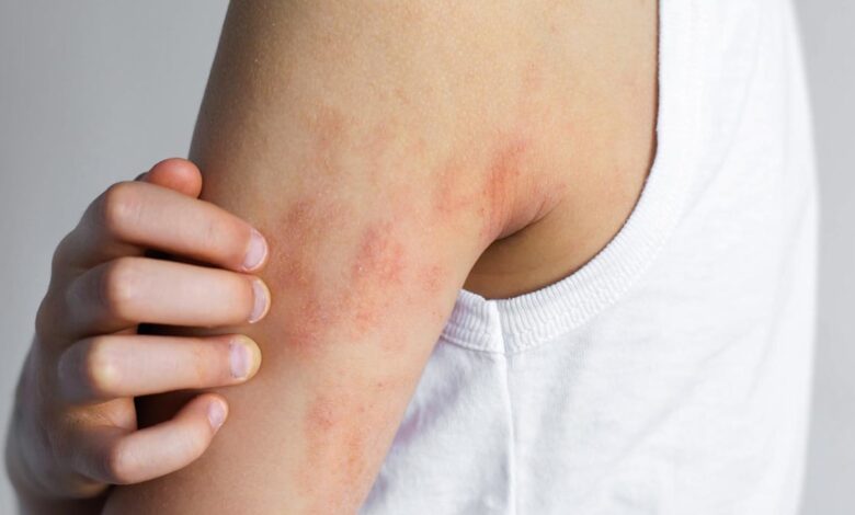 New eczema treatments spark hope, but remain out of reach for many