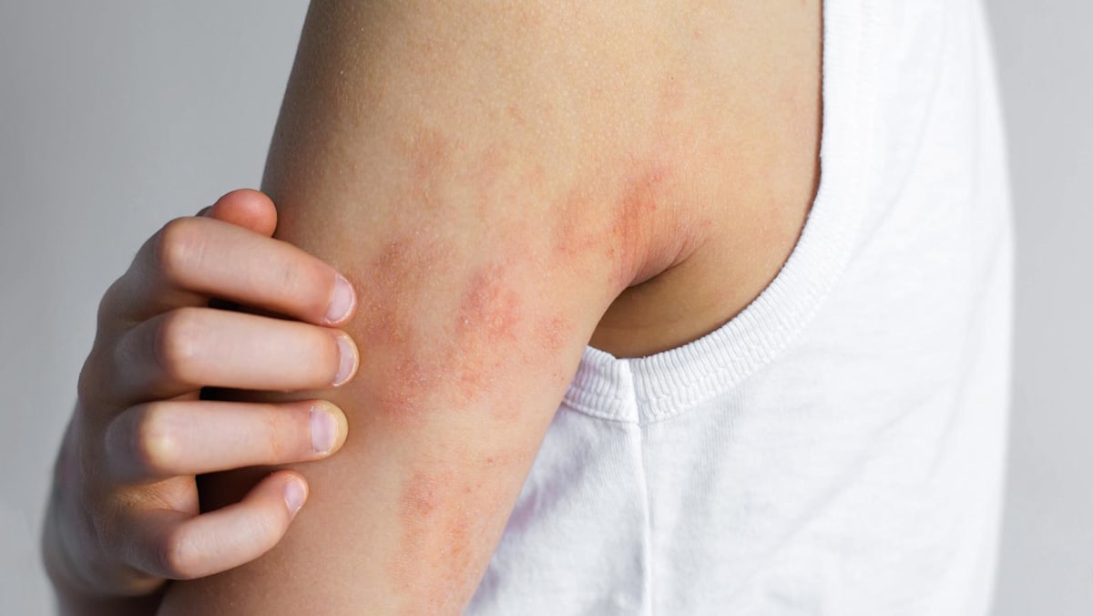 New eczema treatments spark hope, but remain out of reach for many