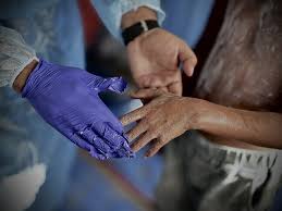 UN reports 125,000 skin infection cases in Gaza linked to rats and parasites